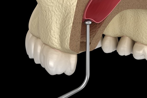 What To Expect If You Need A Sinus Lift Before Getting Dental Implants 