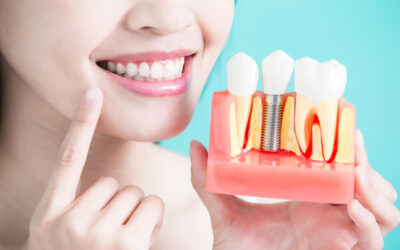 Dental Implant Materials